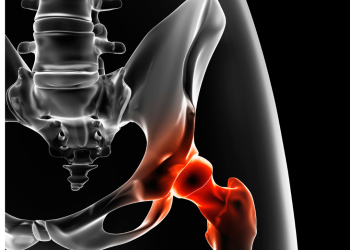 Total Hip Replacement